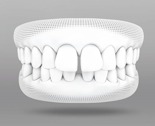 インビザライン Go矯正とインビザラインの違いは？